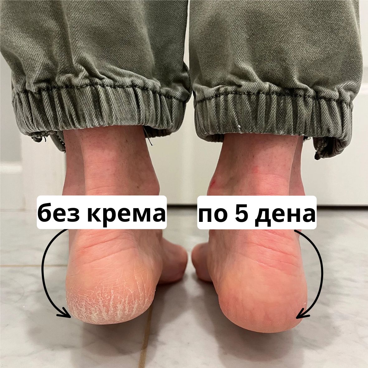 Пета без крема и пета по 5 дена користење на Heel Balm